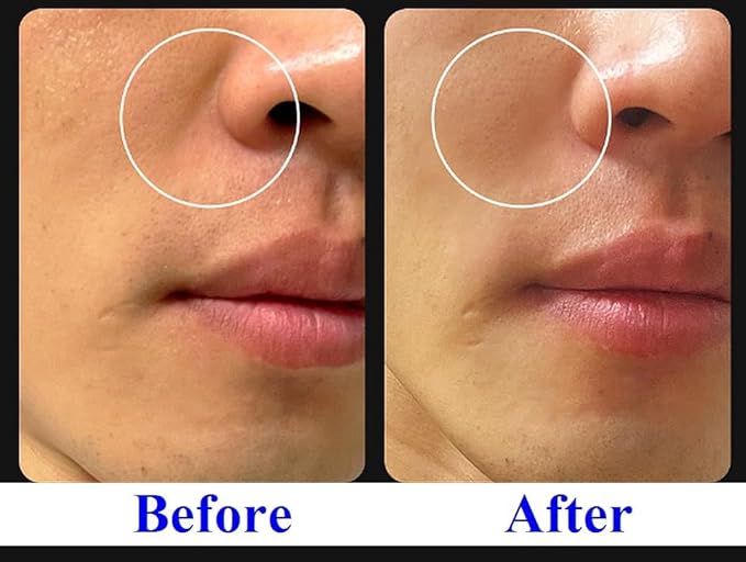 ULTIMATE (0.4%) Retinoid (liposome) Cream ┃Line Lifting and Rejuvenation Concentrate (30ml/1oz)