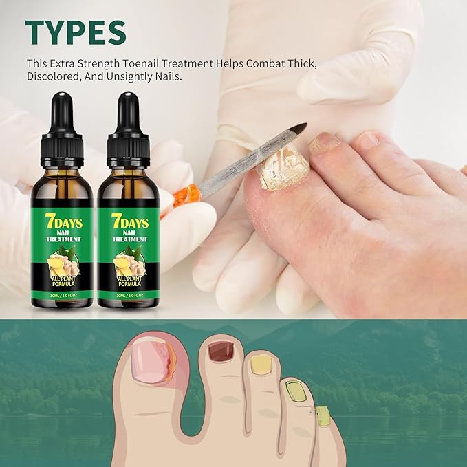 7days Ginger Nail Treatment 2Pcs Nail Support Nail Care, Nail Treatment, Ginger Nail Growth Serum, Ginger Cuticle Care Oil for Nails,Cuticle Serum for Nails