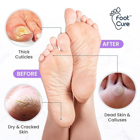 Lavender Foot Soak & Callus Remover Gel Kit - Extra Strength Callus Remover Gel for Feet, Remove Calluses with Epsom Salts, Dry Cracked Heels & Tea Tree Oil Foot Cream - Moisturizing Athletes Foot