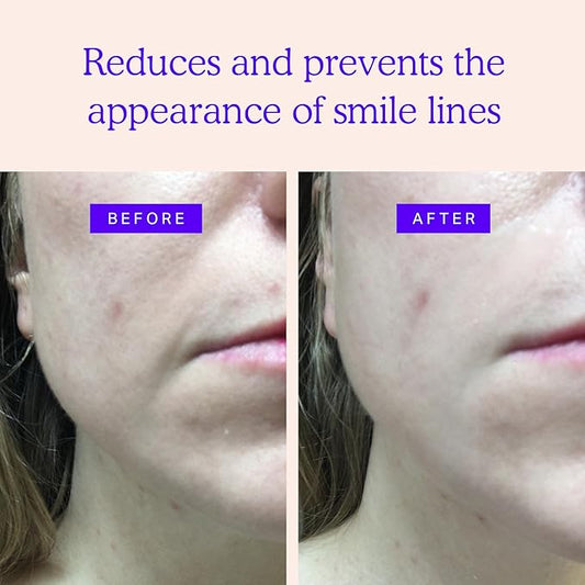 BLUMBODY Smile Line Patches – Face Wrinkle Patches for Fine Lines Around Mouth & between Eyes – Non-Silicone Anti-Wrinkle Facial Tape – Comfortable Overnight Use (90-Day Supply)